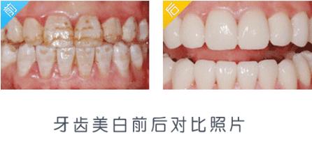 牙白色与米白色区别吗（牙齿两个颜色有米白有纯白的牙齿）-图2